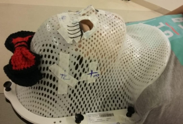 Projeto que personaliza máscaras de radioterapia do Hospital Moinhos de Vento conquista prêmio