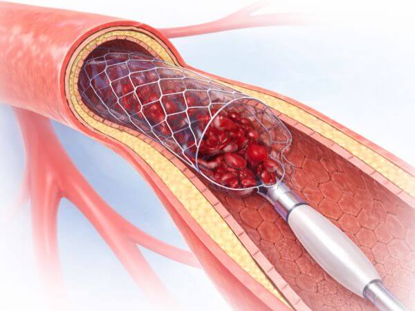 trombectomia mecânica