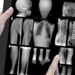 Cura de fraturas em fumantes demoram mais