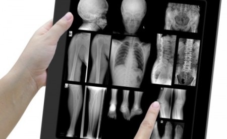 Pesquisadores encontram 42 novos genes relacionados à artrite