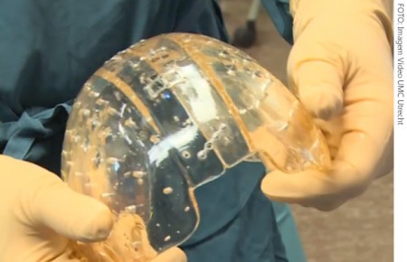 Prótese de crânio em 3D é implantada em mulher