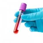 Diagnóstico de Alzheimer por exame de sangue