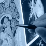 Hospital Moinhos de Vento previne declínio causado por doenças cerebrais
