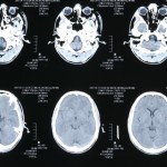 Vacina com tétano pode ajudar no tratamento contra tipo mais comum de tumor no cérebro