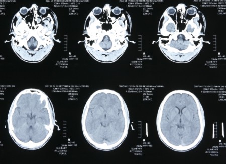 Vacina com tétano pode ajudar no tratamento contra tipo mais comum de tumor no cérebro