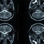 Droga demonstra avanços para o a recuperação da memória ocasionada pelo Alzheimer