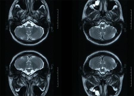 Droga demonstra avanços para a recuperação da memória ocasionada pelo Alzheimer