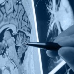 Pesquisa descobre anomalia na origem da doença de Parkinson