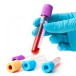 Teste simples de sangue e saliva é eficaz na detecção de cânceres orais