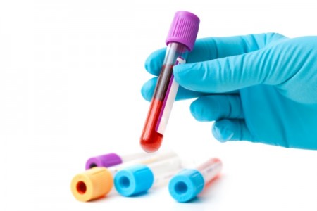 Teste simples de sangue e saliva é eficaz na detecção de cânceres orais