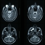 Presença de metal pesado no tecido cerebral após ressonância magnética provoca alerta nos EUA