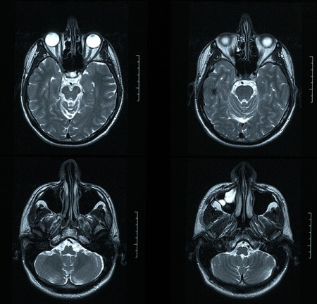 Presença de metal pesado no tecido cerebral após ressonância magnética provoca alerta nos EUA