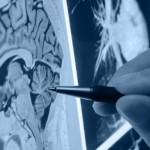 Combinação de medicamento e nanotecnologia abre novo caminho para tratamento de AVC