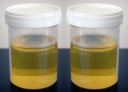 Pesquisa indica que Alzheimer pode ser detectado pelo odor da urina
