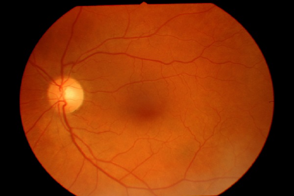 Tratamento se mostra promissor para degeneração macular, uma doença ocular grave