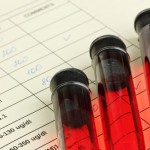 Exame de sangue para diagnosticar Alzheimer mostra 100 de eficiência em testes iniciais