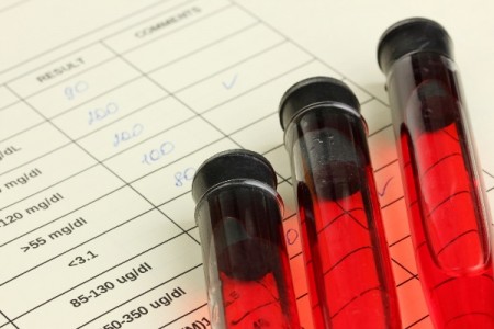 Exame de sangue para diagnosticar Alzheimer mostra 100 de eficiência em testes iniciais