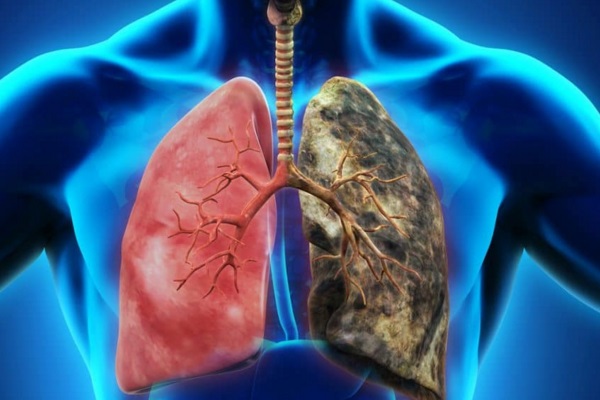 Santa Casa e Hospital da PUCRS desenvolvem estudo pioneiro sobre detecção de câncer de pulmão