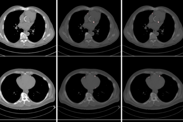 Algoritmo identifica risco de infartos em tomografia comum de tórax