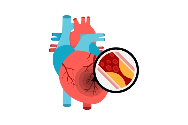 Ligada à principal causa de morte do Brasil, a doença aterosclerótica é decorrente do colesterol LDL alto — Setor Saúde