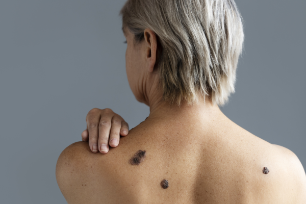 Câncer de pele o desafio do monitoramento em idosos