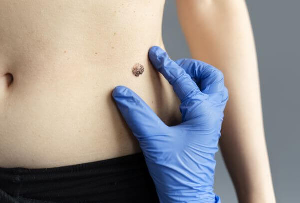 Blitz em POA alerta sobre papel da população no combate preventivo ao câncer de pele